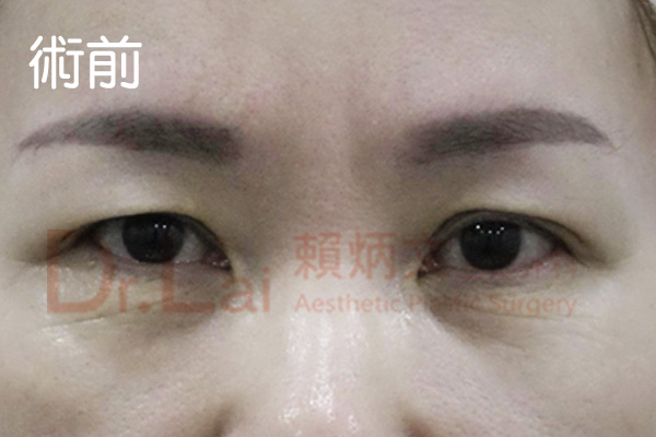 提眉手術