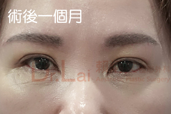 提眉手術