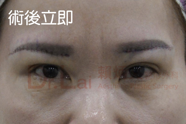 提眉手術
