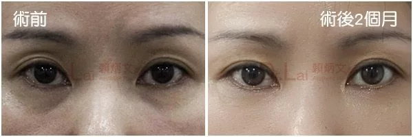 奈米脂肪填補淚溝＆眼窩凹陷案例