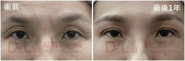 奈米脂肪填補眼窩凹陷案例