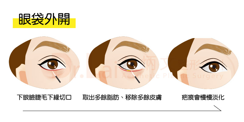 眼袋外開手術示意圖