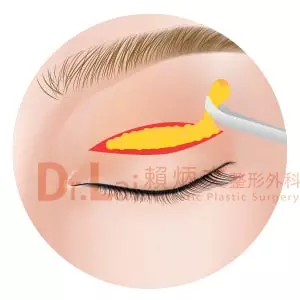 移除過多脂肪如需要時