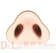 經鼻孔內開法